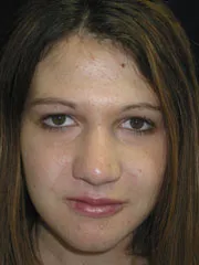 After Jaw Surgery