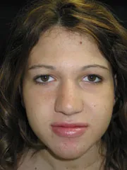 Before Jaw Surgery