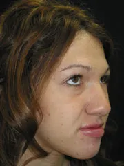 Before Jaw Surgery