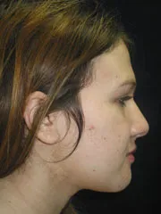 After Jaw Surgery
