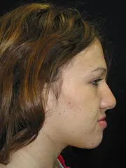 Before Jaw Surgery