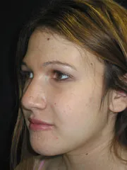 After Jaw Surgery