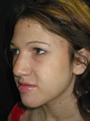 Before Jaw Surgery