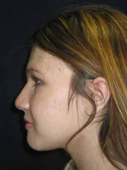After Jaw Surgery