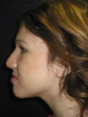 Before Jaw Surgery