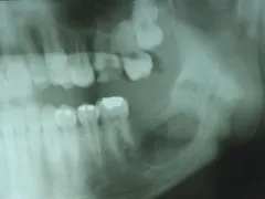 After Jaw Cyst with Impacted Teeth
