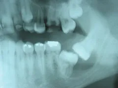Before Jaw Cyst with Impacted Teeth