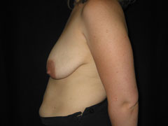 Before Breast Lift with Augmentation