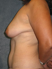 Before Breast Lift, Tummy Tuck
