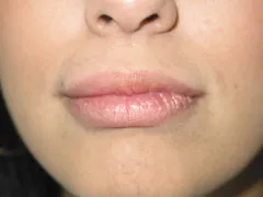 after Lip Augmentation with Autologous Fat