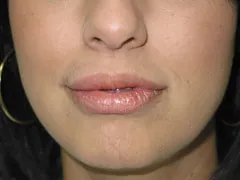 before Lip Augmentation with Autologous Fat