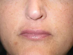 after Lip Augmentation with Autologous Fat