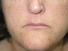 before Lip Augmentation with Autologous Fat