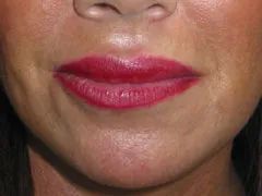 after Lip Augmentation with Autologous Fat