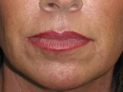 before Lip Augmentation with Autologous Fat