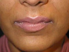 After Lip Augmentation with V-Y Advancement