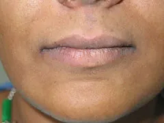 Before Lip Augmentation with V-Y Advancement