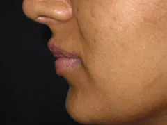 After Lip Augmentation with V-Y Advancement