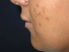 Before Lip Augmentation with V-Y Advancement