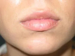 After Lip Augmentation with Restylane