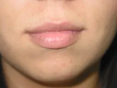 Before Lip Augmentation with Restylane
