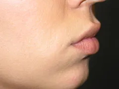 After Lip Augmentation with Restylane