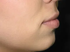 Before Lip Augmentation with Restylane