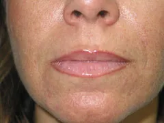 After Lip Augmentation with Restylane