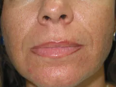 Before Lip Augmentation with Restylane