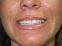 After Lip Augmentation with Restylane
