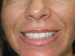 Before Lip Augmentation with Restylane