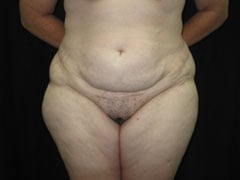 Before Liposuction