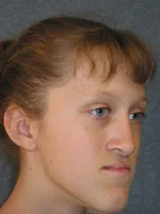 Before Maxillary Advancement, Mandibular Setback