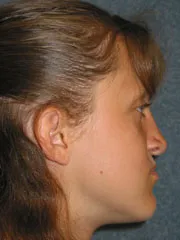 After Maxillary Advancement, Mandibular Setback