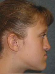 Before Maxillary Advancement, Mandibular Setback