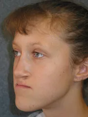 Before Maxillary Advancement, Mandibular Setback