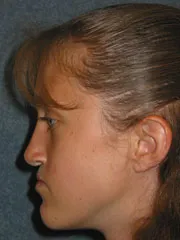 After Maxillary Advancement, Mandibular Setback