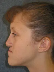 Before Maxillary Advancement, Mandibular Setback