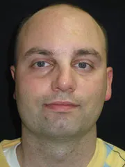 After Nasal Reconstruction