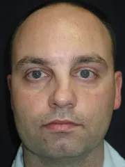 Before Nasal Reconstruction