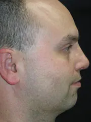 After Nasal Reconstruction