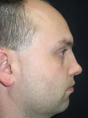 Before Nasal Reconstruction