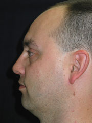 After Nasal Reconstruction