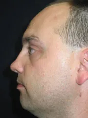 Before Nasal Reconstruction