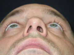 Before Nasal Reconstruction