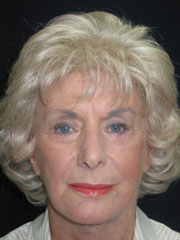 After Blepharoplasty, Face and Neck lift