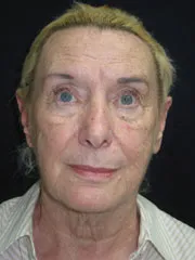 Before Blepharoplasty, Face and Neck lift