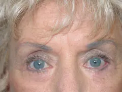 After Blepharoplasty, Face and Neck lift