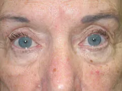 Before Blepharoplasty, Face and Neck lift