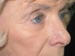 After Blepharoplasty, Face and Neck lift